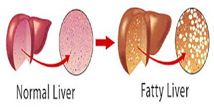 fatty-liver کبد چرب در کودکان و عوامل ایجاد کننده بیماری و درمان آن